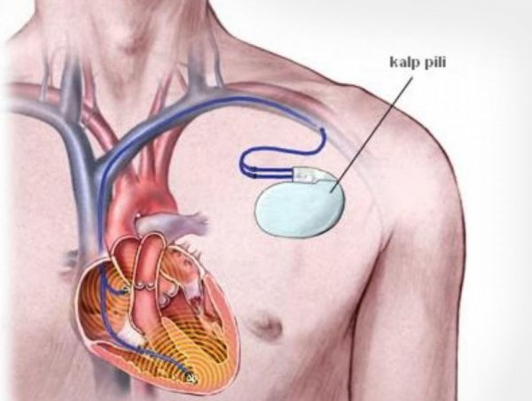 Kalp Yetmezliği Pilleri (Bi-Ventriküler Pacemaker)